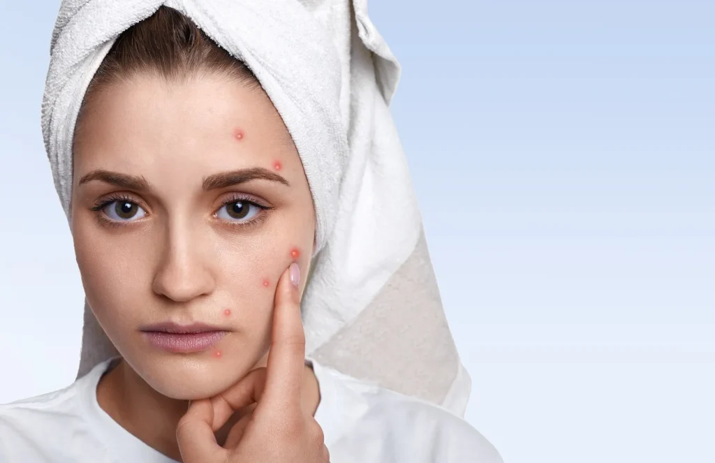 آثار حب الشباب