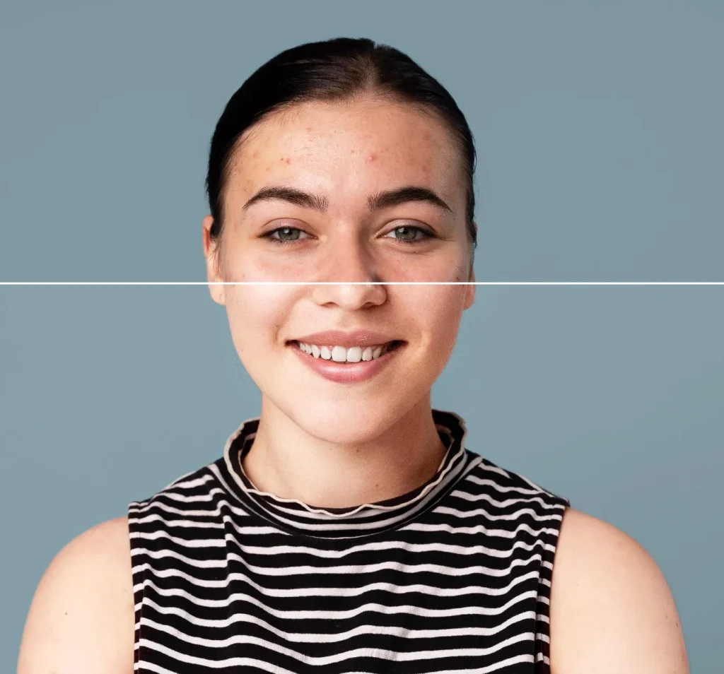 المايكرونيدلينج