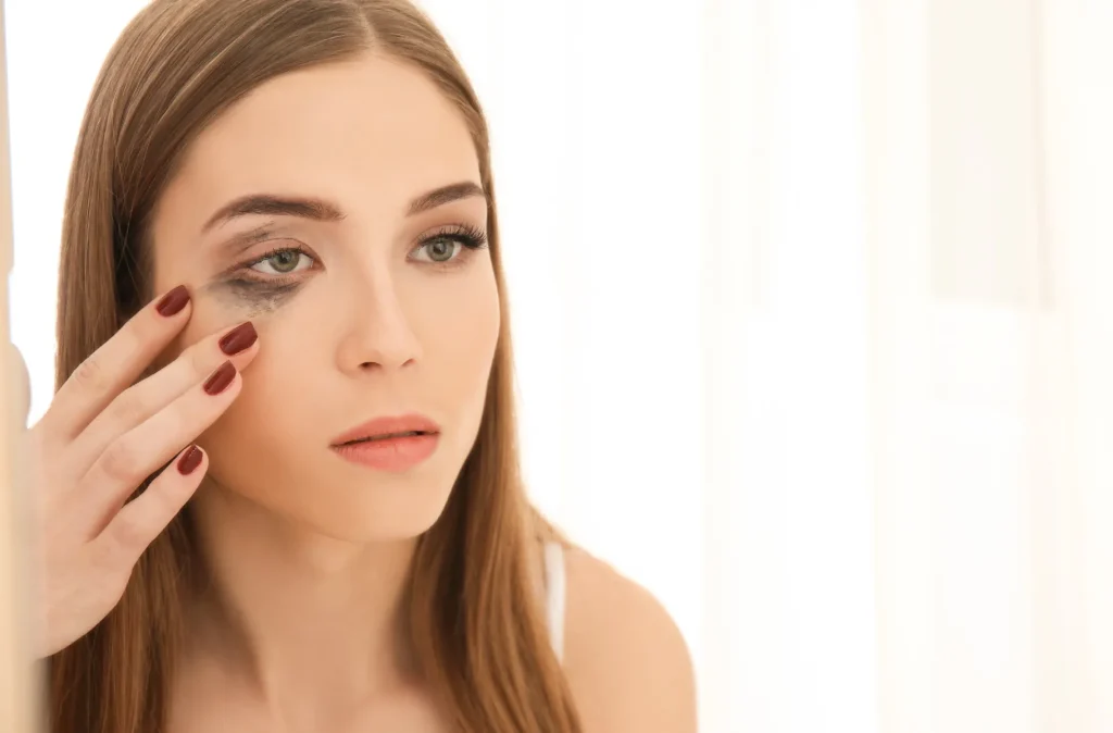 الهالات السوداء