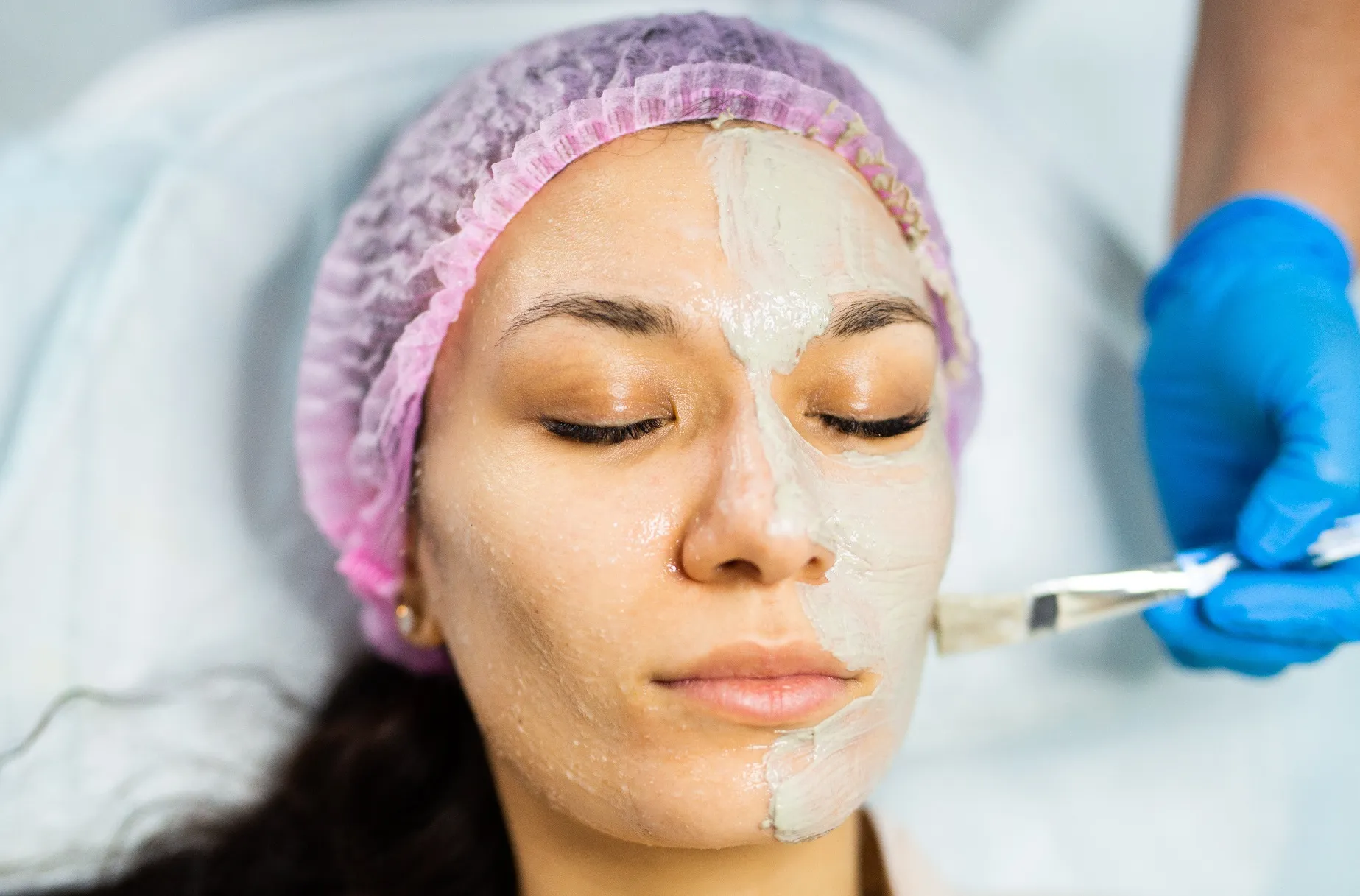 جلسات التقشير الكيميائي للبشرة