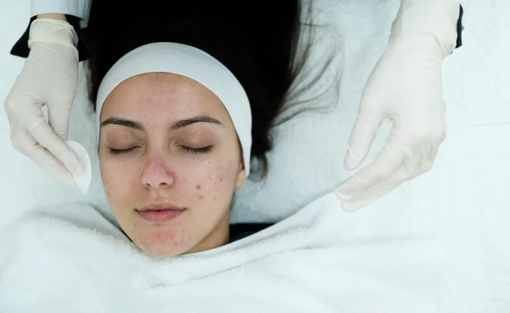 علاج الحبوب الالتهابية