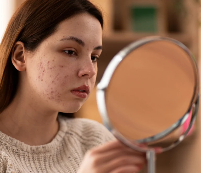 الحل الجذري لعلاج حبوب الشباب: من التشخيص الصحيح إلى العلاج الفعّال