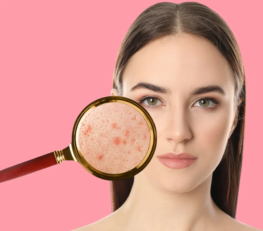 علاج حبوب الشباب